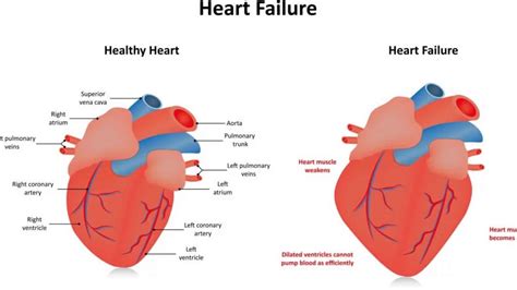 left ventricular hypokinesis